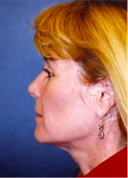 Before Image: Facelift - left-side