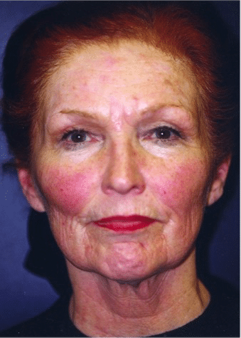 Before Image: Facelift - front