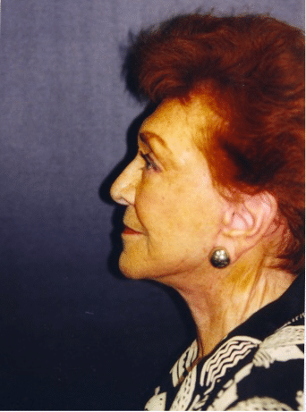 After Image: Facelift - left-side