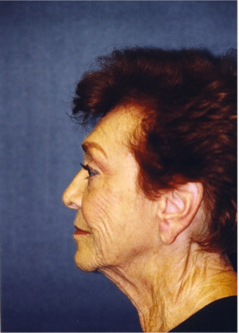 Before Image: Facelift - left-side