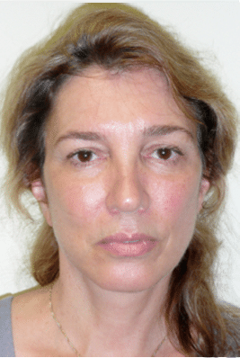 After Image: Facelift - front
