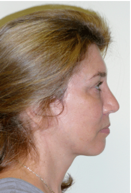 After Image: Facelift - right-side