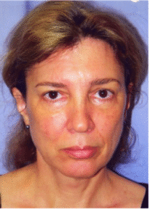 Before Image: Facelift
