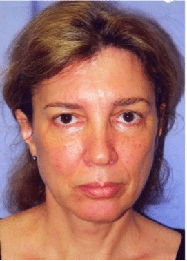 Before Image: Facelift - front