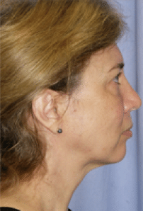 Before Image: Facelift - right-side