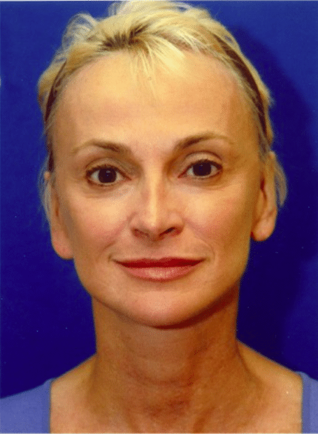 After Image: Facelift - front