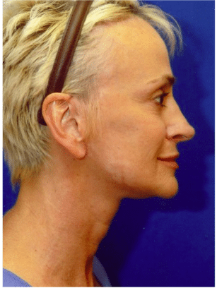 After Image: Facelift - right-side