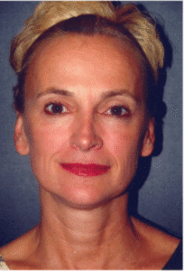 Before Image: Facelift