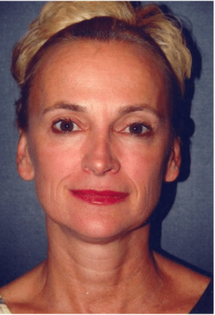 Before Image: Facelift - front