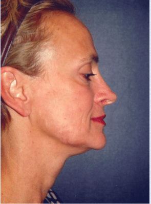 Before Image: Facelift - right-side