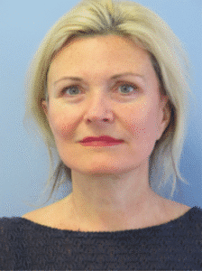 After Image: Facelift