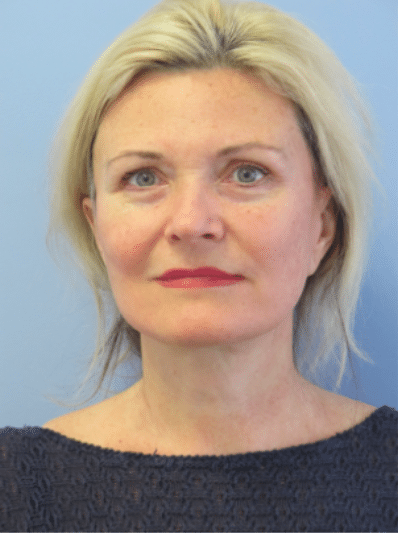 After Image: Facelift - front