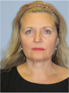 Before Image: Facelift