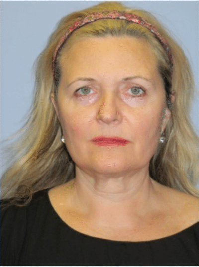 Before Image: Facelift - front