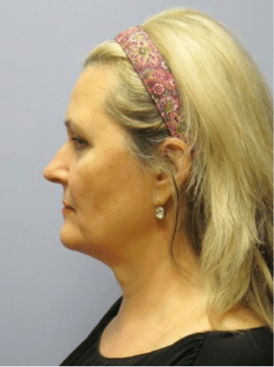 Before Image: Facelift - left-side