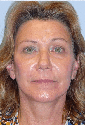 After Image: Facelift - front
