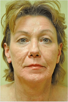 Before Image: Facelift - front