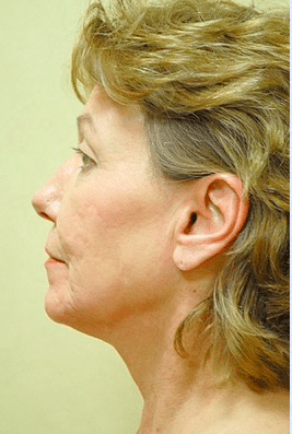 Before Image: Facelift - left-side