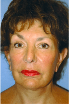 After Image: Facelift - front