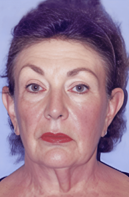 Before Image: Facelift - front