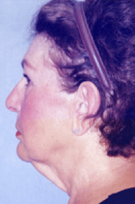 Before Image: Facelift - left-side