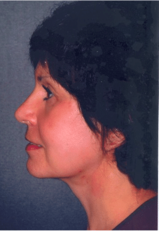 After Image: Facelift - left-side