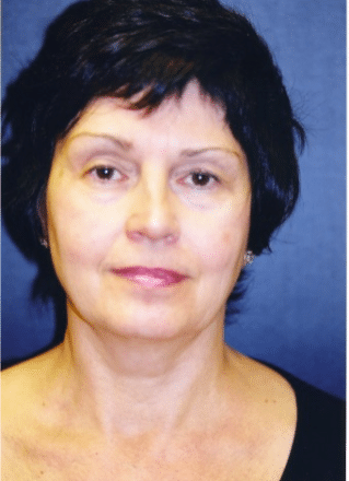 Before Image: Facelift - front