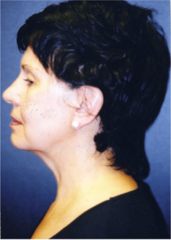 Before Image: Facelift - left-side