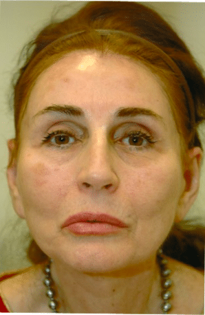 After Image: Facelift - front