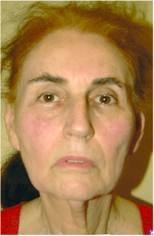 Before Image: Facelift - front