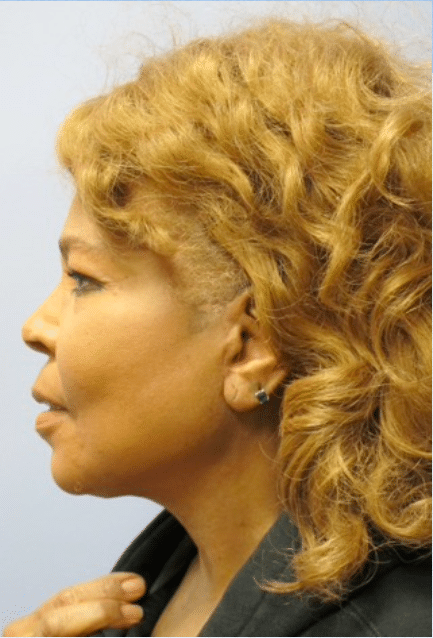 After Image: Facelift - left-side