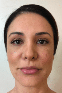 After Image: Fat Transplant