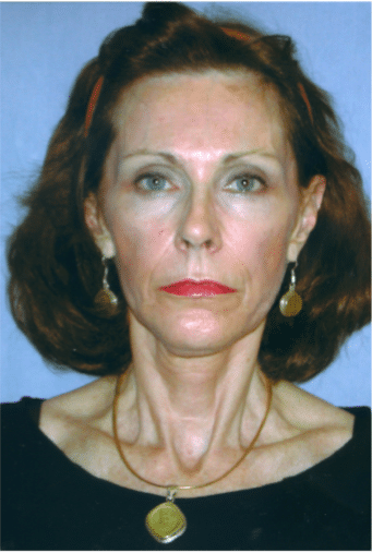 After Image: Fat Transplant - front