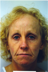 Before Image: Fat Transplant