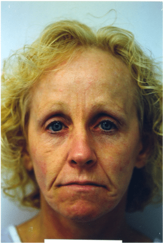 Before Image: Fat Transplant - front