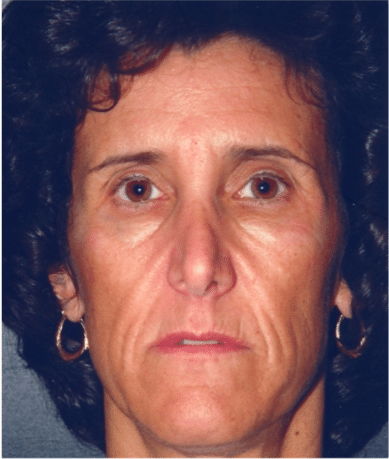 Before Image: Fat Transplant - front