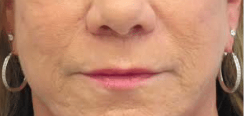 After Image: Lip Lift - front
