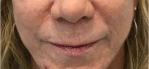 Before Image: Lip Lift