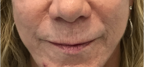 Before Image: Lip Lift - front