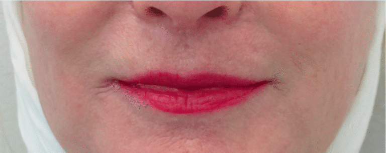 After Image: Lip Lift - front