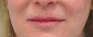 Before Image: Lip Lift