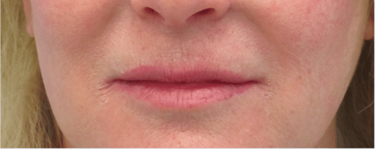 Before Image: Lip Lift - front