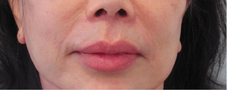 After Image: Lip Lift - front