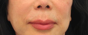 Before Image: Lip Lift
