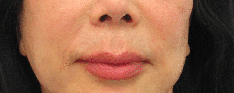 Before Image: Lip Lift - front