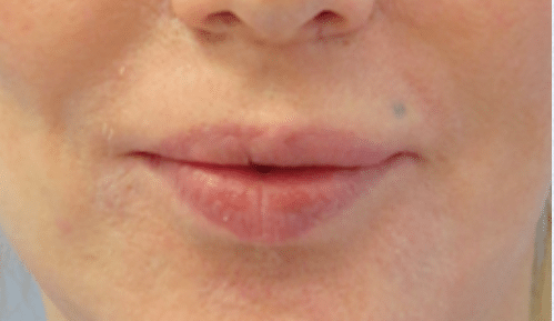 After Image: Lip Reduction - front