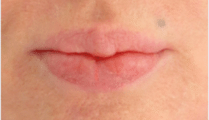 Before Image: Lip Reduction