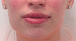 After Image: Lip Reduction