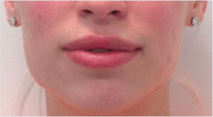 After Image: Lip Reduction - front
