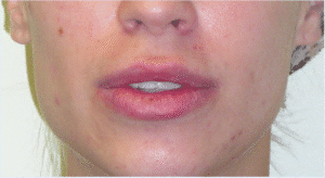 Before Image: Lip Reduction